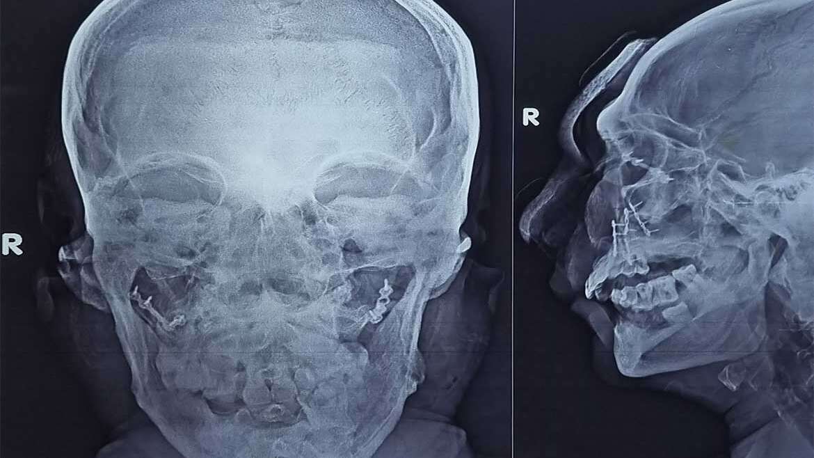 Facial Injury and Jaw Fractures