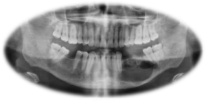 Benign Cyst and Tumors
