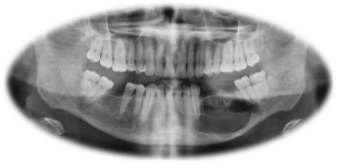 Benign Cyst and Tumors